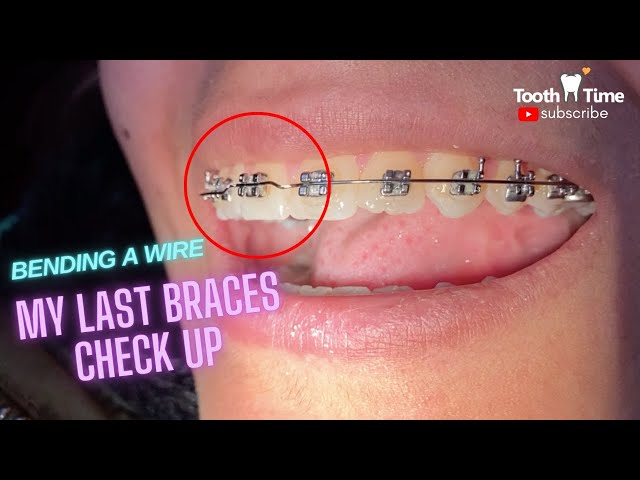 My ortho did not change wire for 6 months now. Is that normal? Also, do you  think I have crowded arch? : r/braces