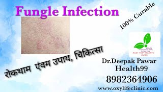 Fungle Infection #skincare #skininfection