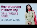 Hysteroscopy in Infertility. Typical Tuberculosis features.