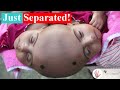 Conjoined Twins Rabia and Rukia's Separation That Lasted 1 Full Year! ~ Body Bizarre!