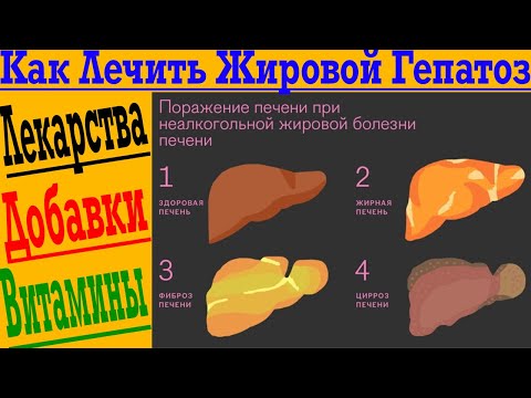 Как быстро вылечить жировой Гепатоз печени!