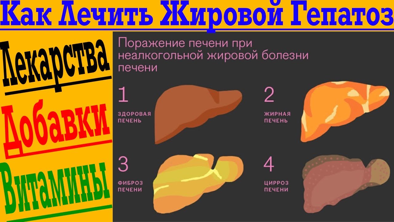 Как быстро вылечить жировой Гепатоз печени! - YouTube