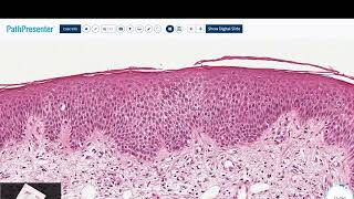 SPONGIOTIC DERMATITIS