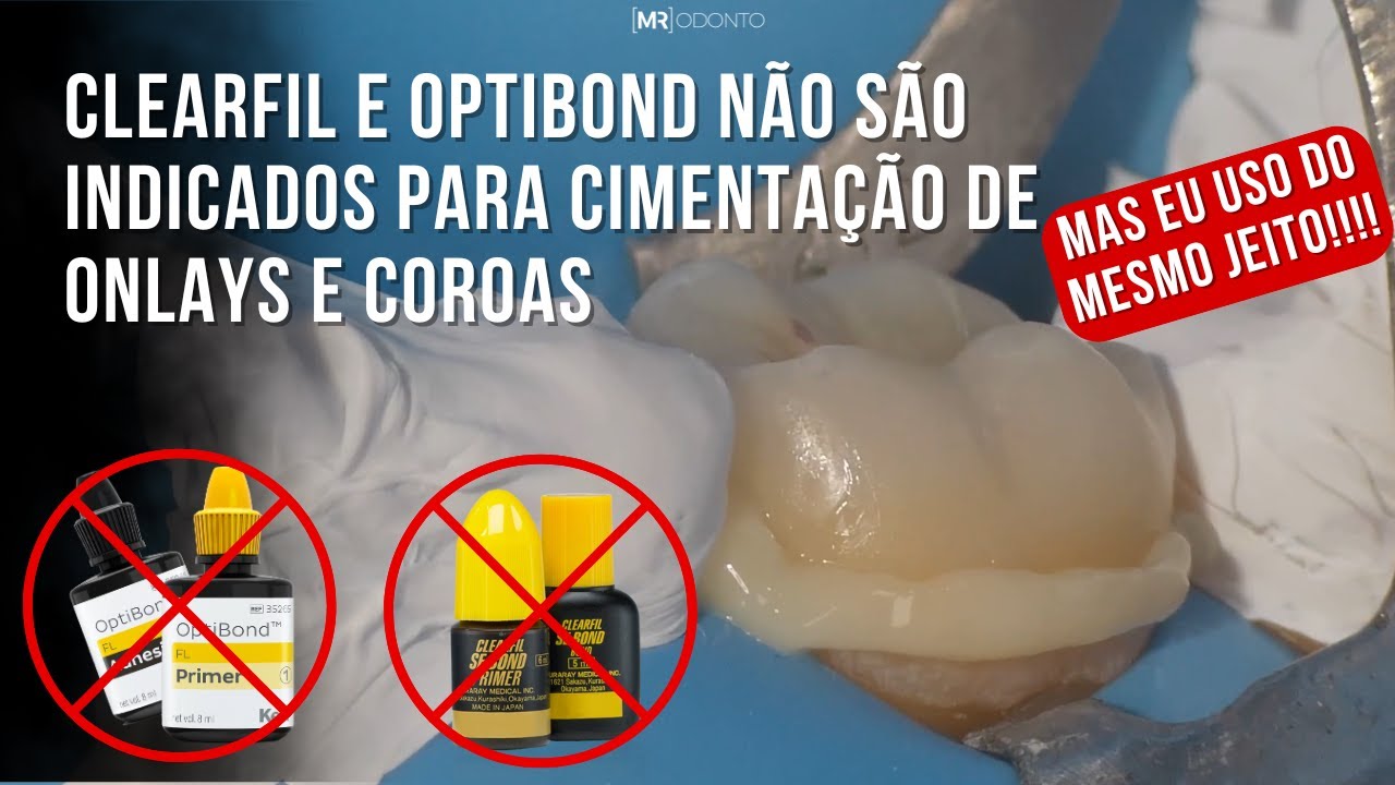 CLEARFIL E OPTIBOND NÃO SÃO INDICADOS PARA CIMENTAÇÃO DE ONLAYS E COROAS, MAS EU USO MESMO ASSIM