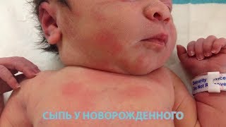 Сыпь на теле новорожденного Сыпь на теле новорожденного