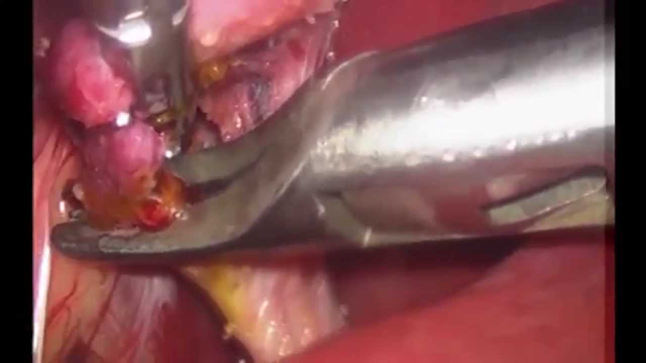 Colelitíase (cálculo de vesícula biliar )/ Cholelithiasis (gall bladder calculus) doutor estranho filme