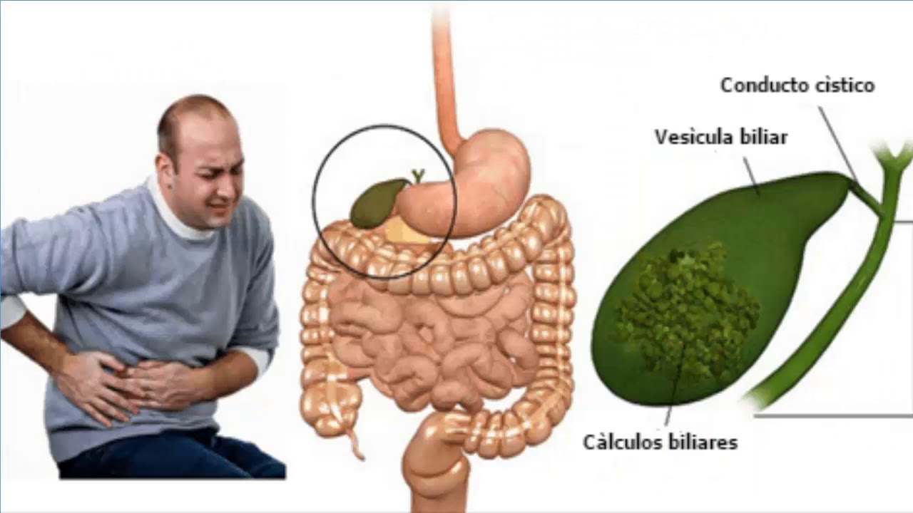 Где могут быть камни у человека. Желчнокаменная болезнь пигментные камни. Камни в почках 2 мм как выглядит. Где могут быть камни у человека. Конкременты желчного пузыря.
