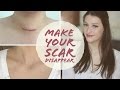 HOW TO FADE SURGERY SCARS | Thyroidectomy | Scar Care | Graves' Disease