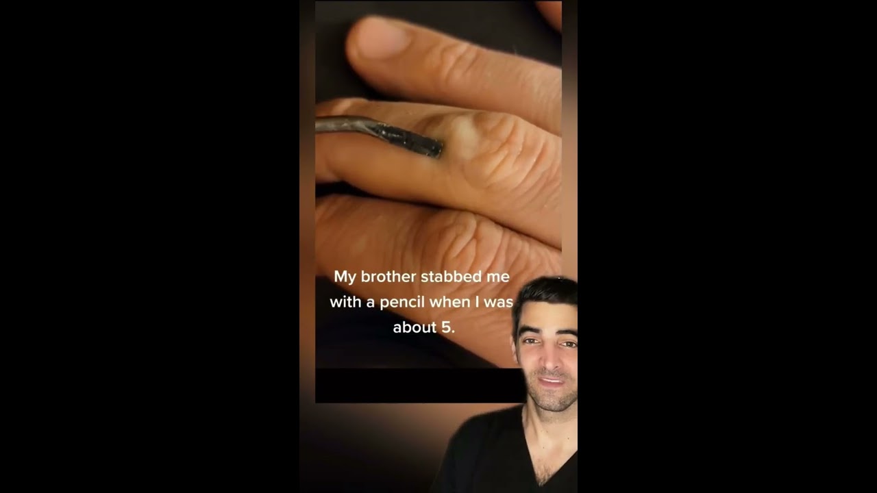 Lead Stuck In The Finger