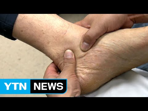 바람만 스쳐도 아픈 통풍...치료 효과 7배 늘린다 / YTN