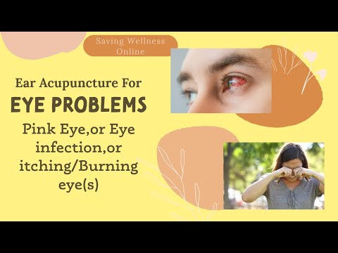 Video: Kā ārstēt rozā aci (konjunktivīts) (ar attēliem)