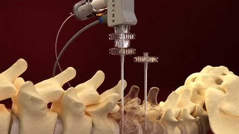 PML1009-AB  Introducer Video.wmv