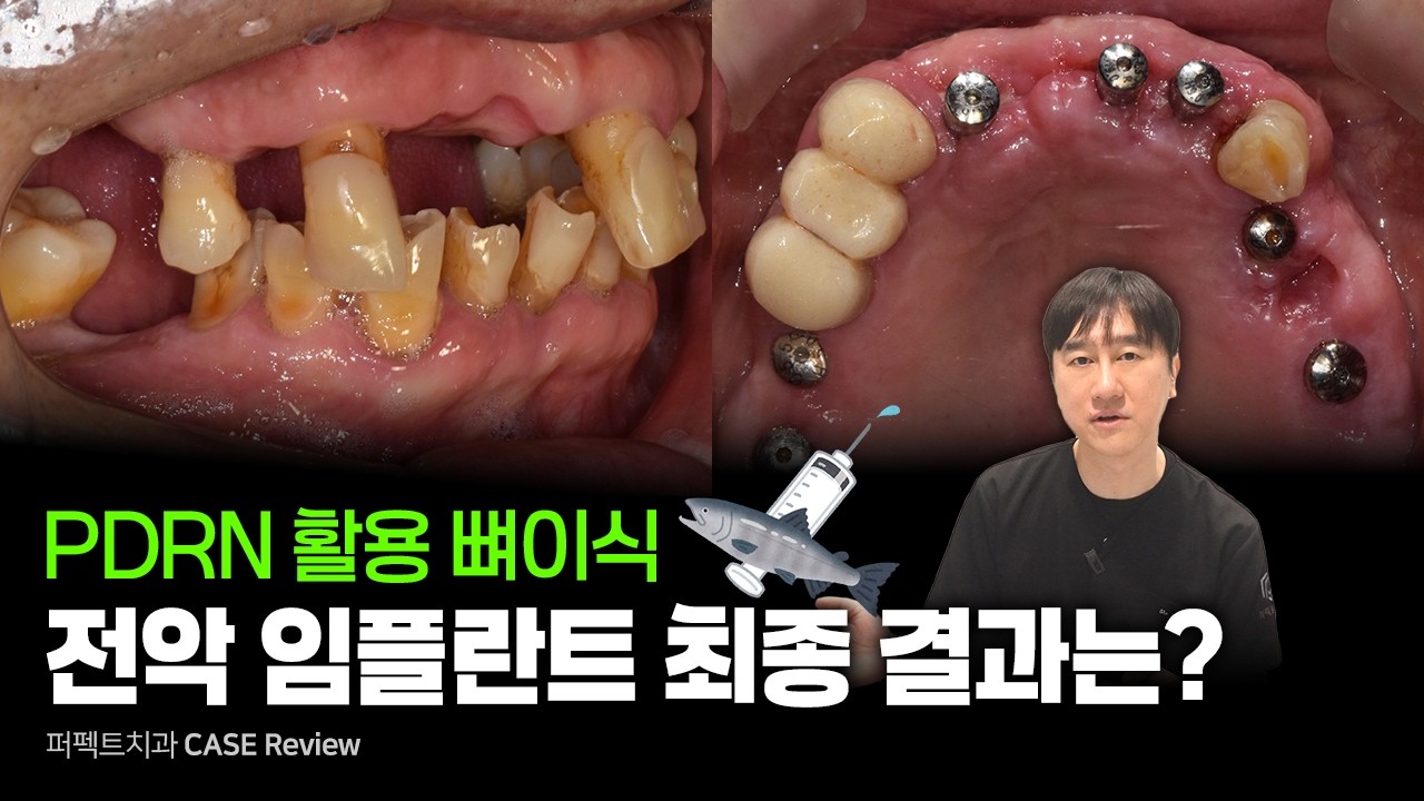 흔들리는 치아 빼고 전악 임플란트, 브릿지, 뼈이식 (PDRN주사)