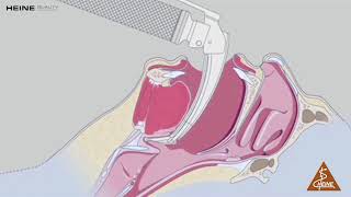 HEINE Flextip  — F.O Laryngoscope Blade