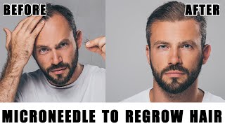 Doctor Reveals: Does Microneedling and Dermarolling Really Work for Hair Loss?