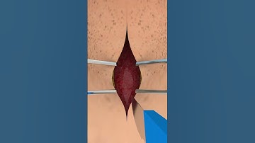 How Tracheotomy Tube Work #short #ytshorts  - creativelearning3d