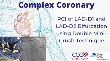 PCI of LAD-D1 and LAD-D2 ﻿Bifurcation using Double Mini-Crush Technique