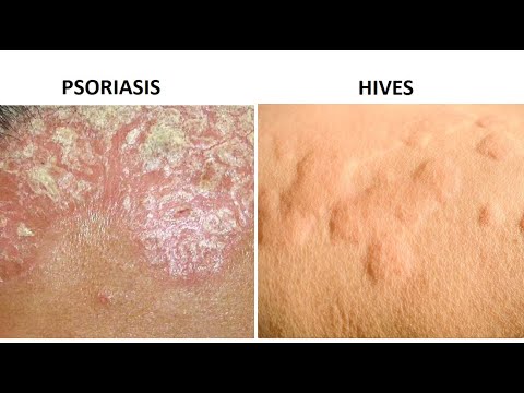 Psoriasis or Herpes: Which Is It ?