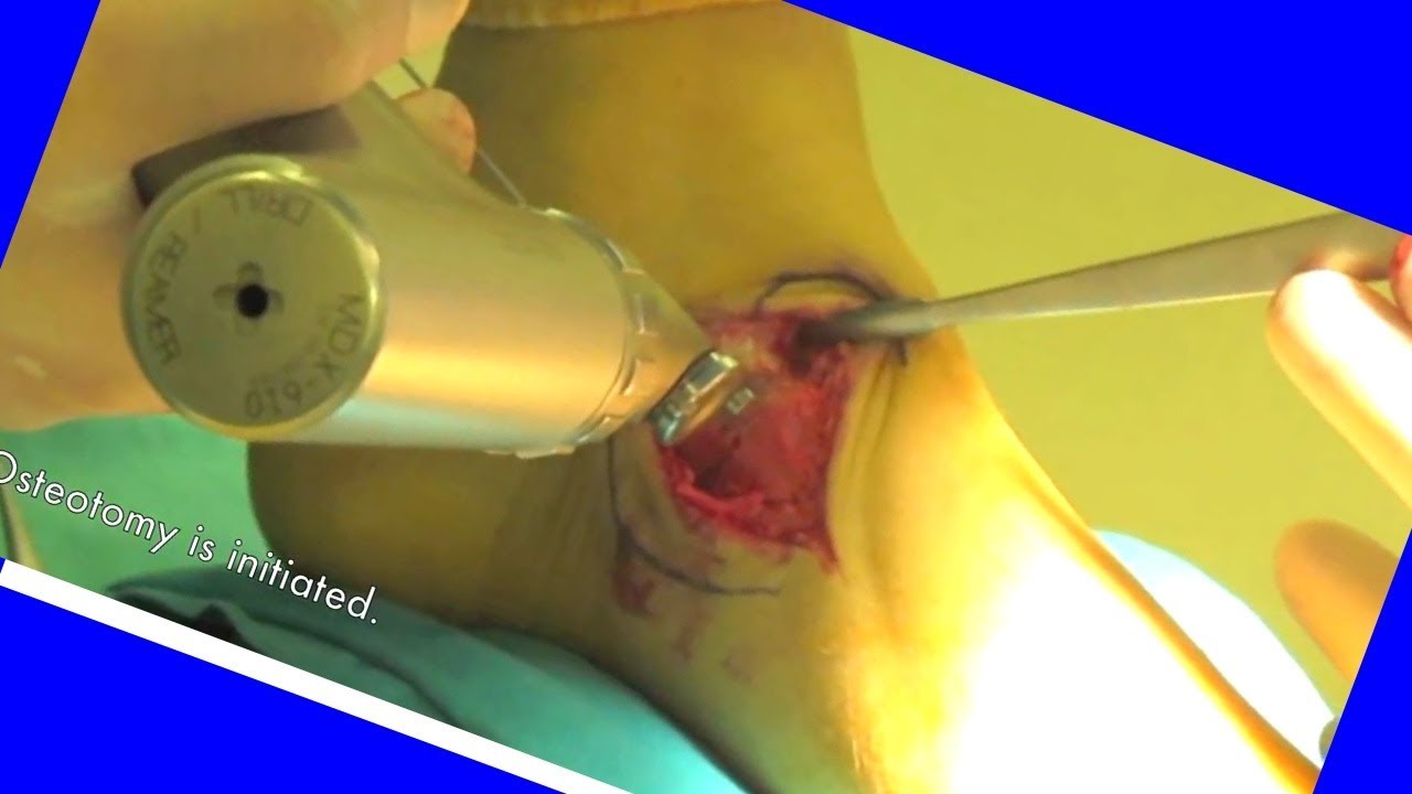 The mosaicplasty  technique for osteochondral lesions of the talus.