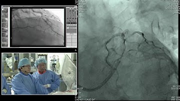 [TCTAP 2017] Coronary Symposium - Live Case & Lecture Session VII