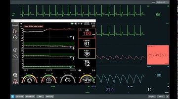 HPI case study 1 - clinical utility of dP dt