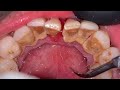 HOW TO REMOVE TARTAR BUILDUP | Dentist | Dokter Gigi Tri Putra