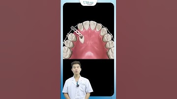 Cách Bác Sĩ Kéo Răng Mọc Ngầm Khi Niềng Răng | Nha Khoa Minh Châu