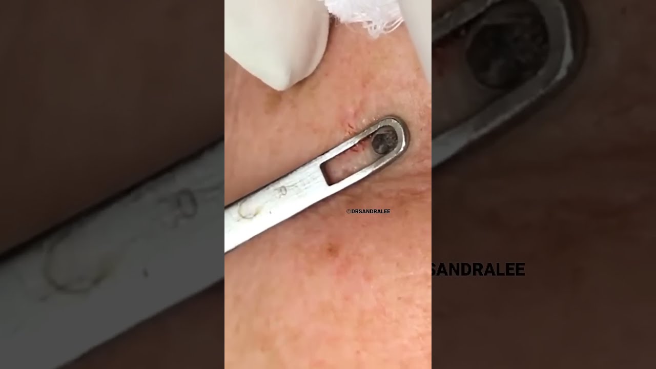 Removing A BIG Dilated Pore Of Winer Dr Pimple Popper Shorts Drpimplepopper
