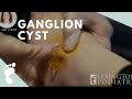 "Oddly Satisfying" | Oozing Ganglion Cyst