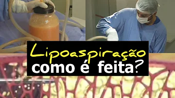 Quais os procedimentos para fazer lipoaspiração?