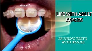HOW I KEEP MY ADULT BRACES CLEAN | BRACES CLEANING ROUTINE 2020