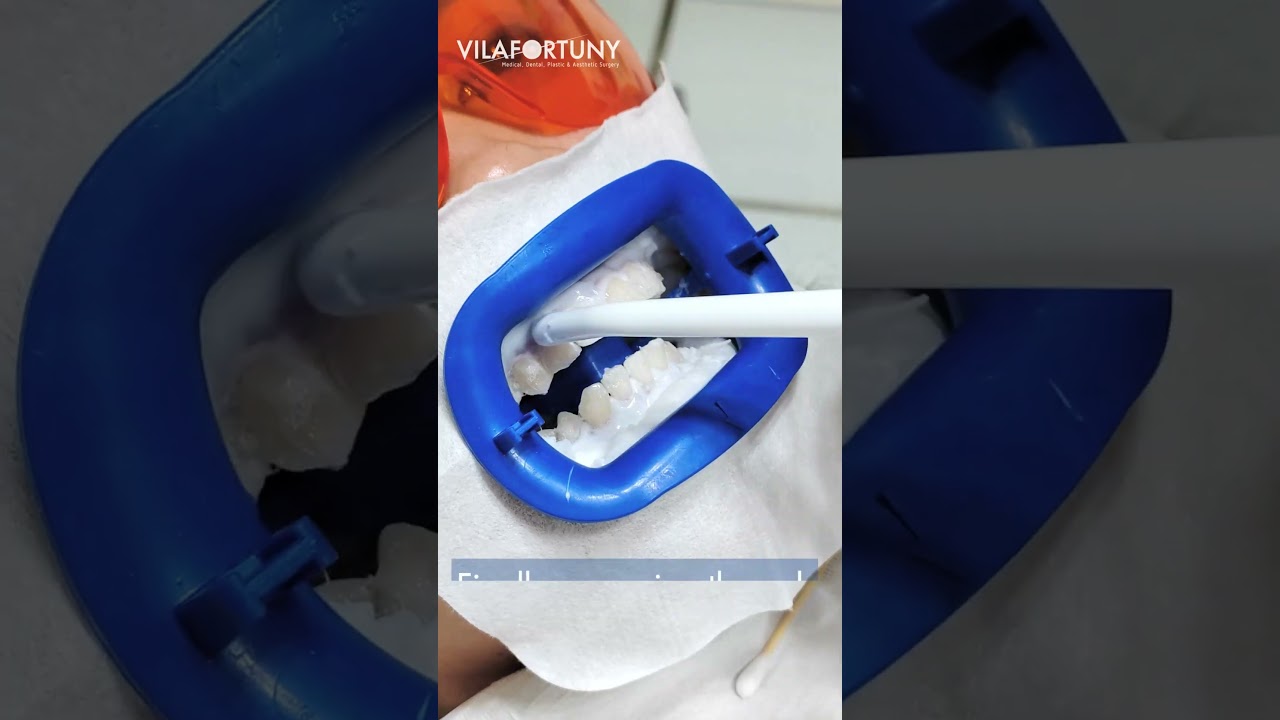 Teeth Whitening at Vilafortuny - Transform Your Look in Minutes | Vilafortuny, Dubai