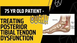 75 Year Old Patient with Posterior Tibial Tendon Dysfunction & How we Treated it
