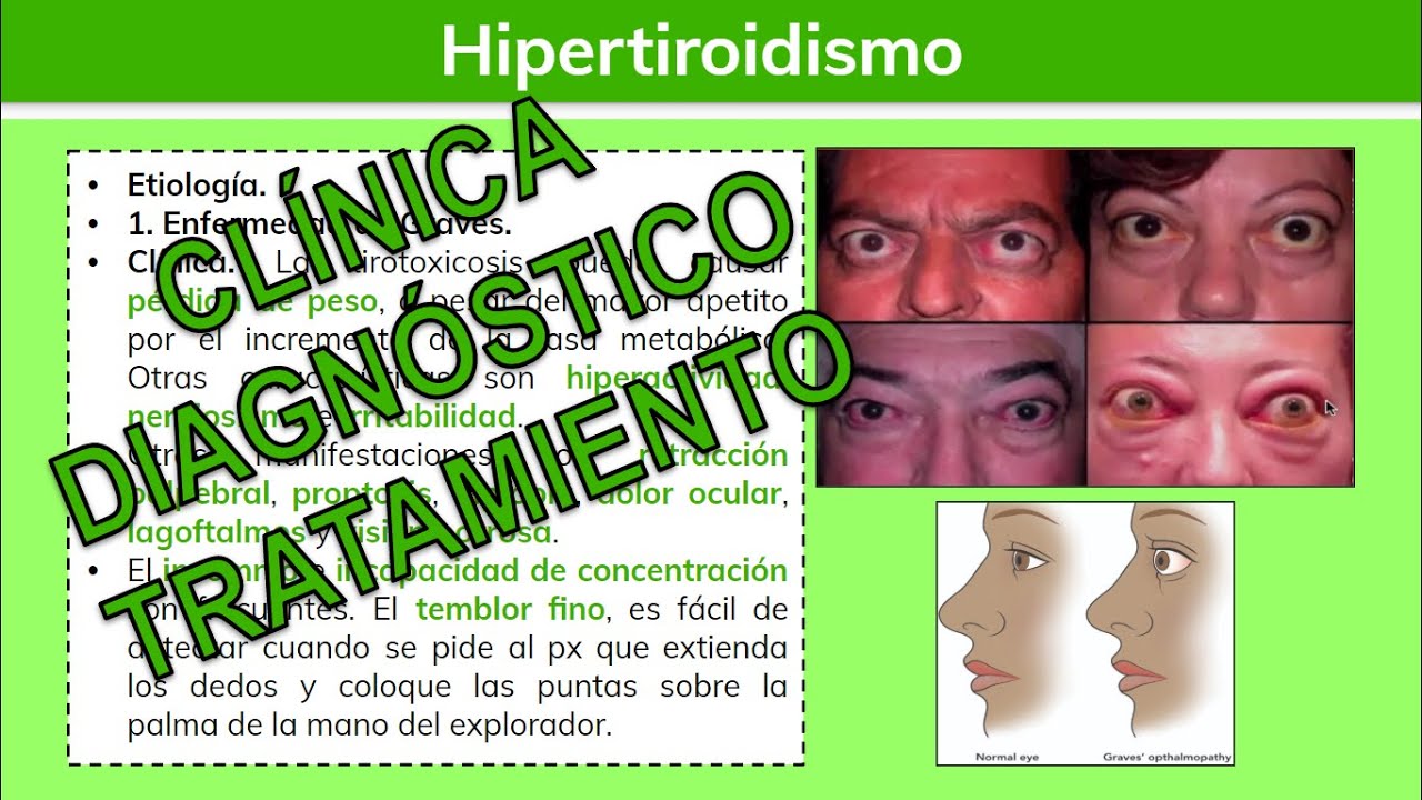 Hipertiroidismo subclínico dieta