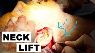 NECK LIFT AND SALIVARY GLAND REMOVAL