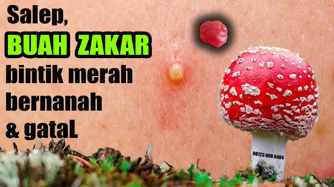 Cara mengobati bentol merah gatal pada penis dan kulit buah zakar YouTube