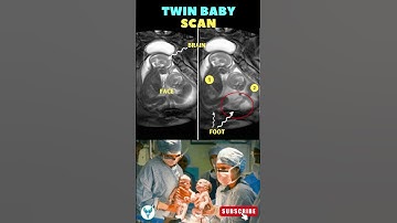 🥰 Double the Joy : Twin Baby Ultrasound Scans Revealed 👶👶 #pregnancy #shortsfeed #baby#twins