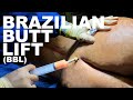 Brazilian Butt Lift (BBL) - Dr. Paul Ruff | West End Plastic Surgery