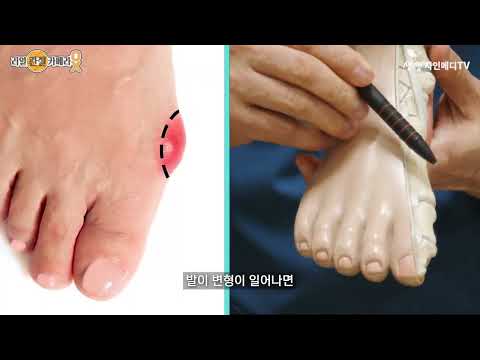 더자인병원 엄지발가락 통증의 원인이 바로 '이것' 때문이라면! feat 무지외반증