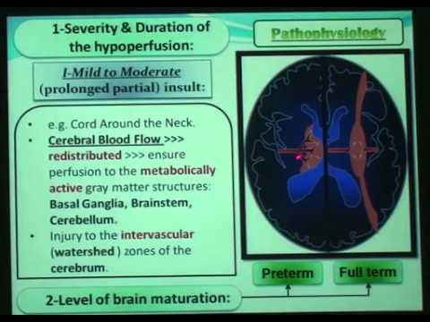 Video: Feline Ischemic Encephalopathy Hauv Tsev Menyuam Miv