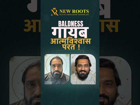Grade 6 Transformation 😮 | 5000 Grafts | Aurangabad #hairtransformation #shorts