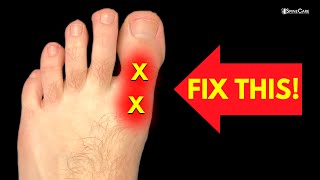 How to Fix BIG TOE Pain for Good