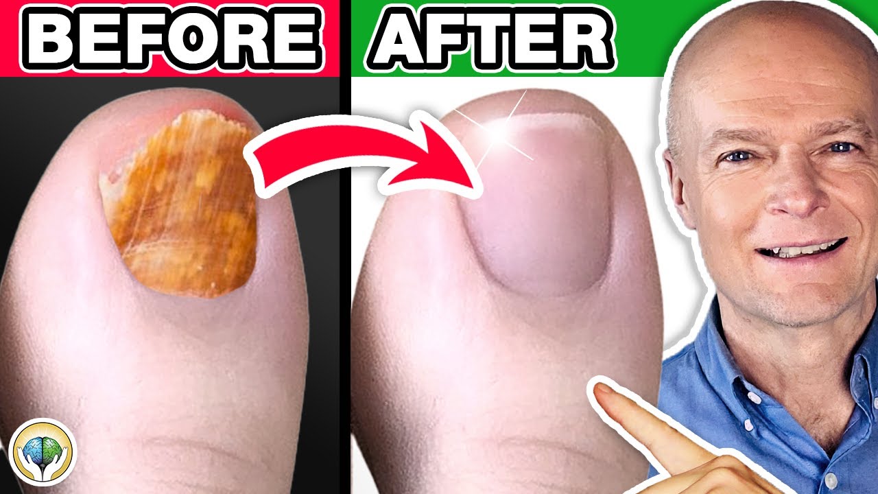 Best Home Remedy Toenail Fungus | Natural Remedy for Nail Fungus