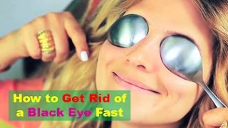 Download Lagu How to Get Rid of a Black Eye Fast, Safely and Naturally MP3 Download Lagu How to Get Rid of a Black Eye Fast, Safely and Naturally MP3