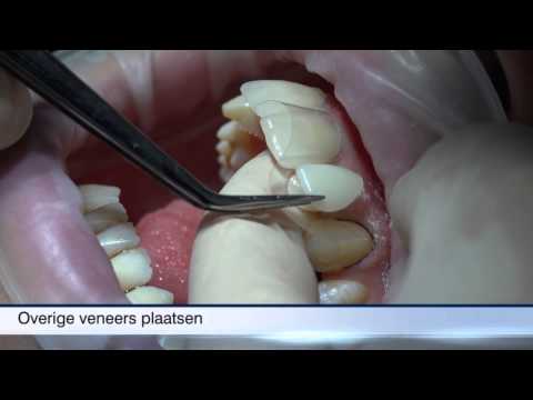 Video: Oorzaken, Risicofactoren En Behandelingen Voor Kleine Tanden