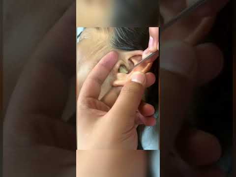 Satisfying Video Ear Wax Removal | how to remove ear wax by endoscopic ear #short P170