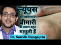 Lupus disease - ल्यूपस बीमारी का Symptom और treatment क्या है। sle disease in hindi