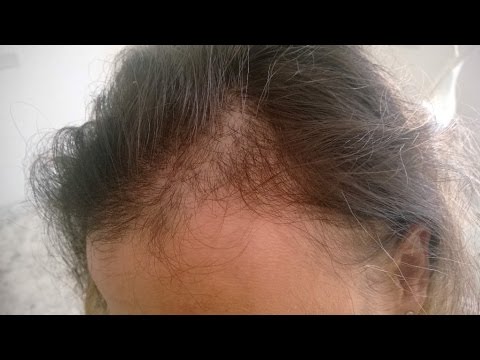 parrucche per alopecia femminile