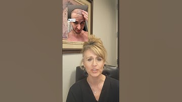 Scabbing after hair restoration: it’s normal! 👩🏼‍⚕️🥼 #hairrestoration #menshair #hairhelp