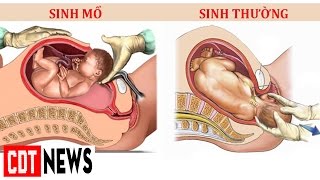 Download LỢi – HẠi CỦa Sinh MỔ So VỚi Sinh ThƯỜng Ai CŨng PhẢi BiẾt | Cdt News Video MP3 LỢi – HẠi CỦa Sinh MỔ So VỚi Sinh ThƯỜng Ai CŨng PhẢi BiẾt | Cdt News